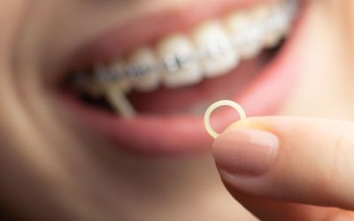 Centra Dental - Why Are Rubber Bands Used in South Houston Braces Treatment?