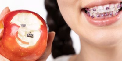 Centra Dental - Top 5 Foods to Avoid When You Have Houston Braces