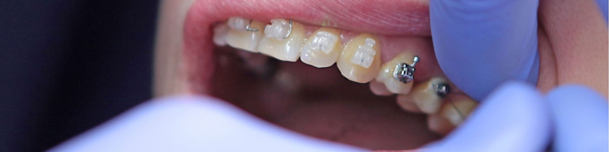 Centra Dental - What Type of Houston Braces Is Best for You?