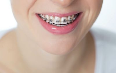 Centra Dental - How Metal Houston Braces Work