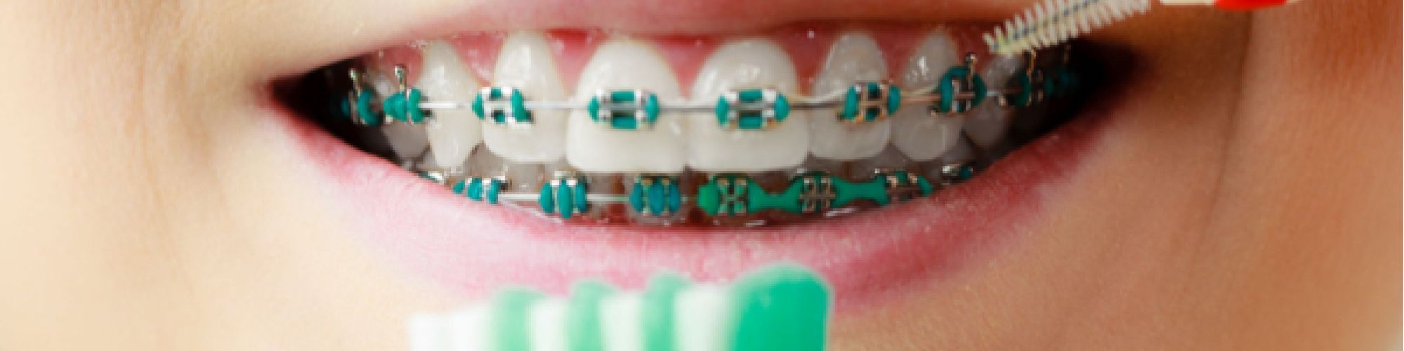 Centra Dental - The Importance of Proper Hygiene and Dental Check-Ups When Wearing South Houston Braces