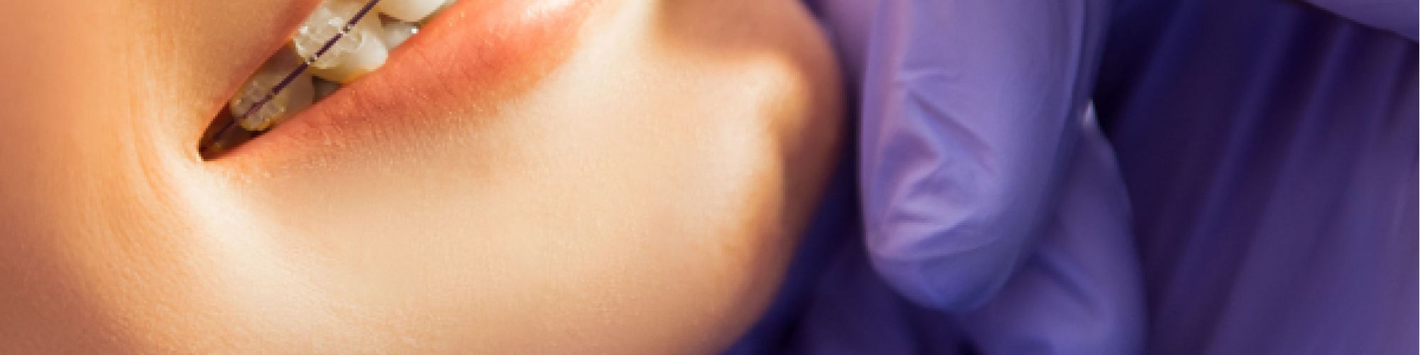 Centra Dental - Daily Habits for Optimal Houston Braces Hygiene