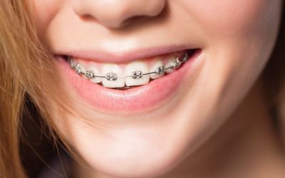 Centra Dental - How to Keep Your Teeth Clean While Wearing South Houston Braces