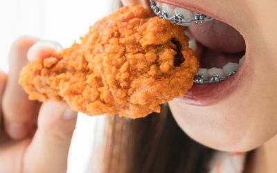 Centra Dental - Foods to Avoid With Houston Braces