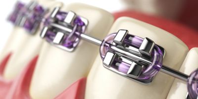 Centra Dental - How To Get The Most Out Of Metal Houston Braces