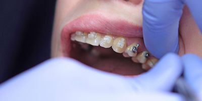 Centra Dental - What Type of Houston Braces Is Best for You?