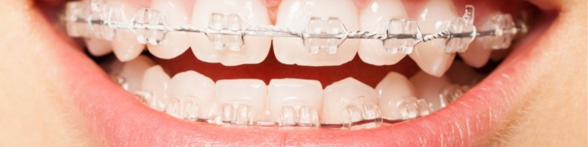 Centra Dental - Maintain Your South Houston Invisalign Smile With Clear Retainers
