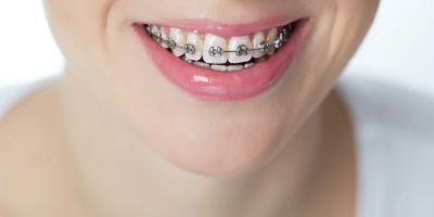 Centra Dental - How Metal Houston Braces Work