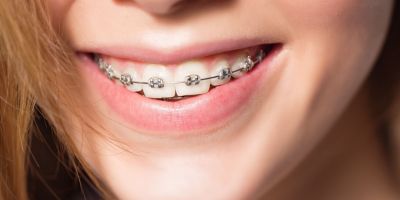 Centra Dental - How to Keep Your Teeth Clean While Wearing South Houston Braces