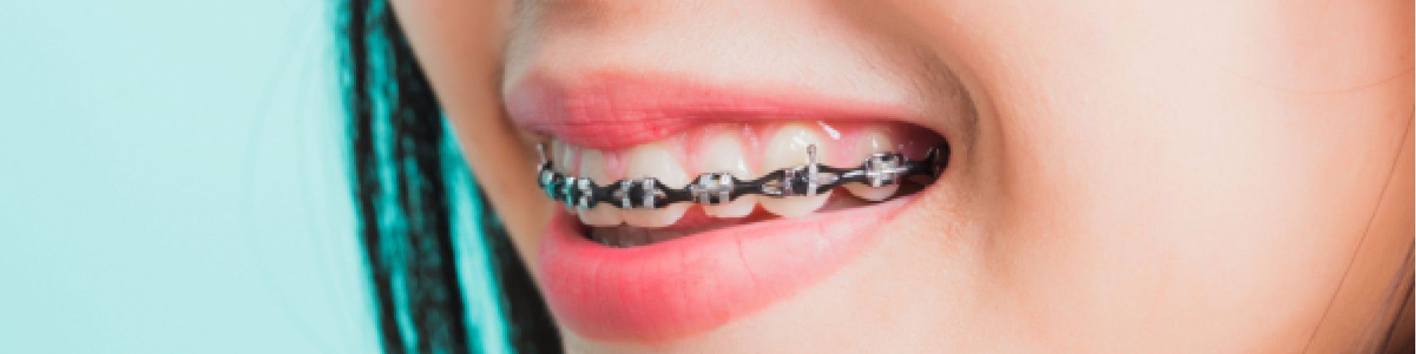 Centra Dental - Ceramic Houston Braces Versus Metal Braces, A Quick Introduction