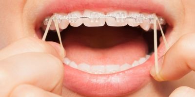 Centra Dental - Why You Might Need Rubber Bands with Houston Braces