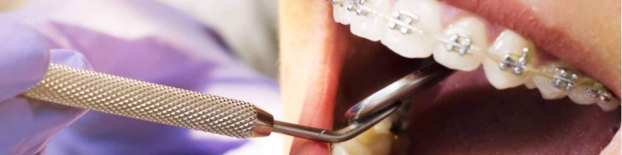 Centra Dental - Houston Braces for Adults