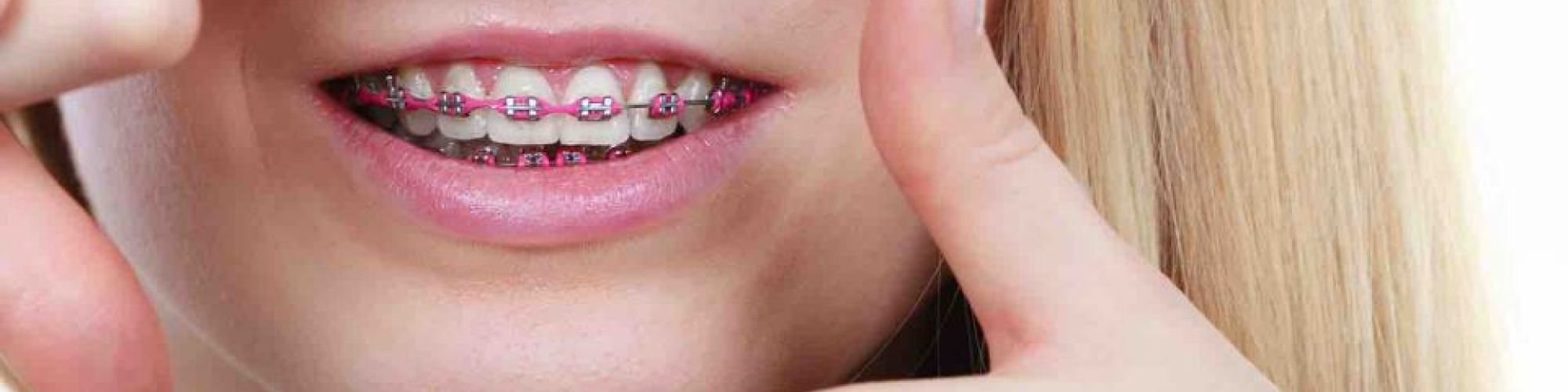 Centra Dental - Launch Your Spring with Braces