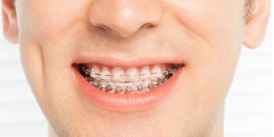 Centra Dental - The Pros and Cons of Ceramic vs Metal South Houston Braces
