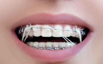 Centra Dental - When Do South Houston Braces Patients Have to Wear Rubber Bands?