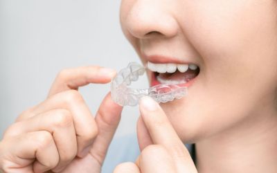 Centra Dental - How South Houston Invisalign Works