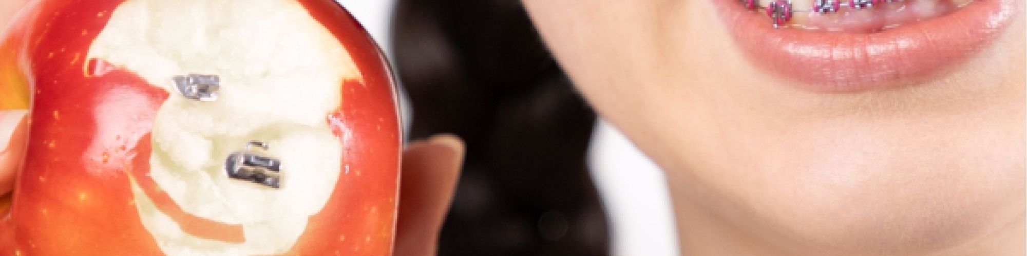 Centra Dental - Top 5 Foods to Avoid When You Have Houston Braces