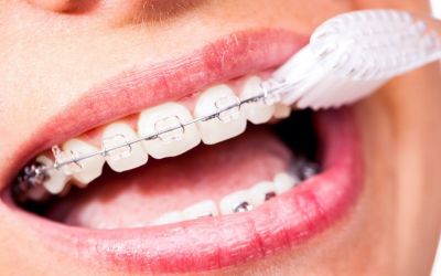 Centra Dental - How to Keep Your Teeth Clean and Healthy While Wearing Houston Braces
