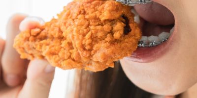 Centra Dental - Foods to Avoid With Houston Braces