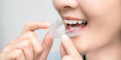 Centra Dental - How South Houston Invisalign Works
