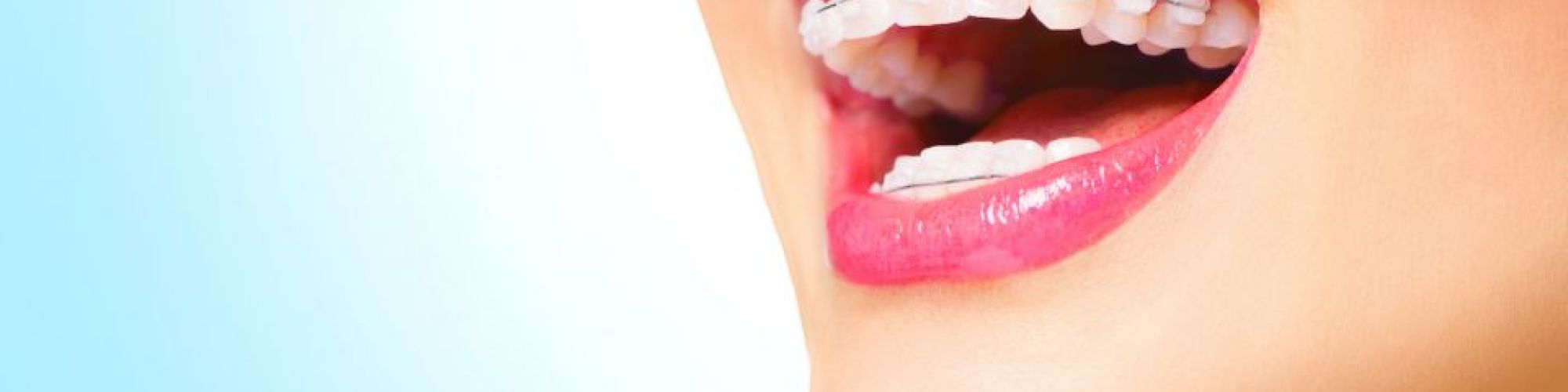 Centra Dental - When Our South Houston Family Dentists Recommend Ceramic Houston Braces