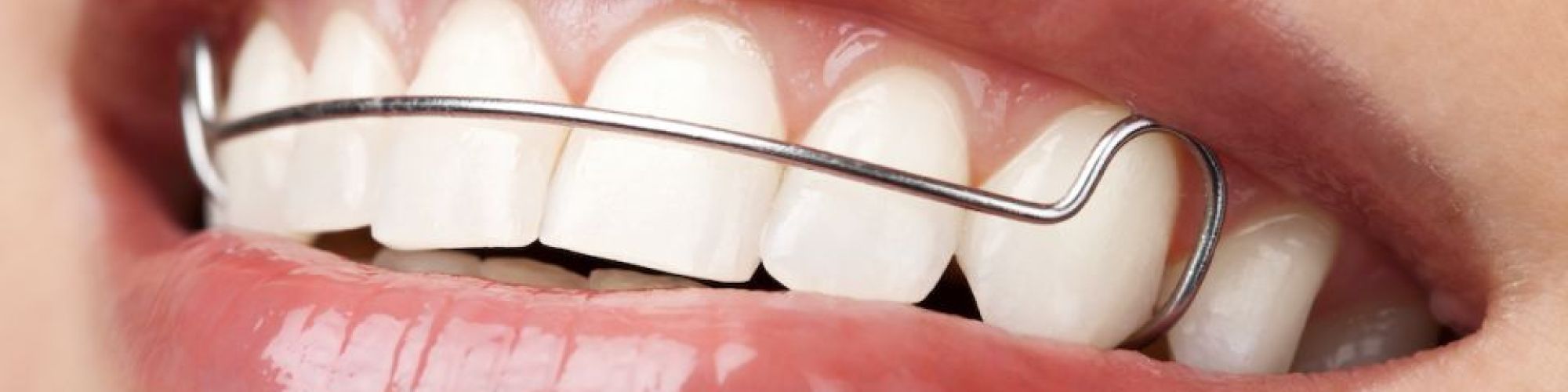 Centra Dental - Wear Your Retainers After Houston Braces Treatment