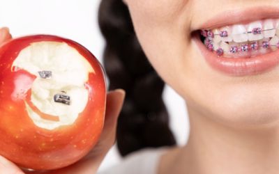 Centra Dental - Top 5 Foods to Avoid When You Have Houston Braces