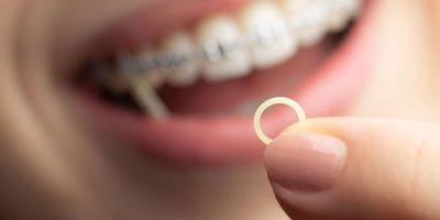 Centra Dental - Why Are Rubber Bands Used in South Houston Braces Treatment?