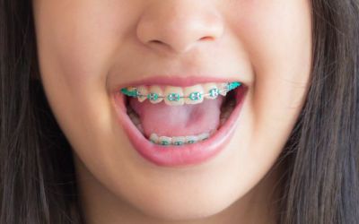 Centra Dental - Houston Metal Braces For Children