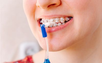 Centra Dental - Maintaining Your Oral Hygiene While Undergoing Houston Braces Treatment