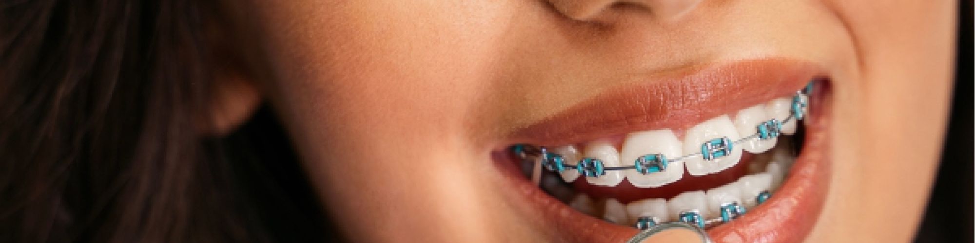 Centra Dental - How Long Do You Need to Have Houston Braces?