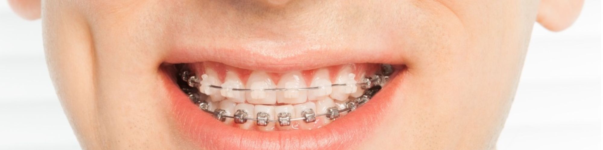 Centra Dental - The Pros and Cons of Ceramic vs Metal South Houston Braces