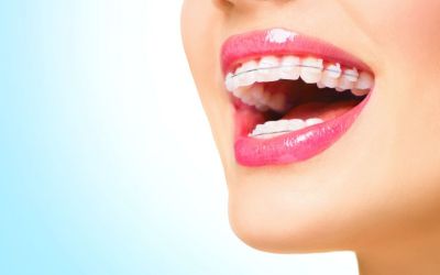 Centra Dental - When Our South Houston Family Dentists Recommend Ceramic Houston Braces