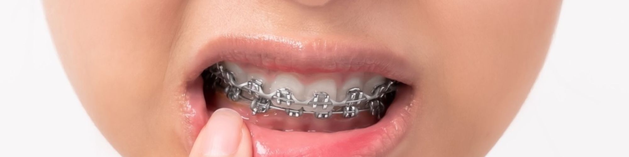 Centra Dental - How to Manage ﻿Houston Braces Pain