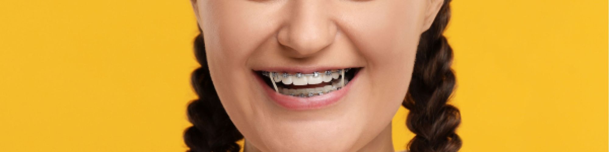 Centra Dental - The Importance of Wearing Your Elastics with Houston Braces