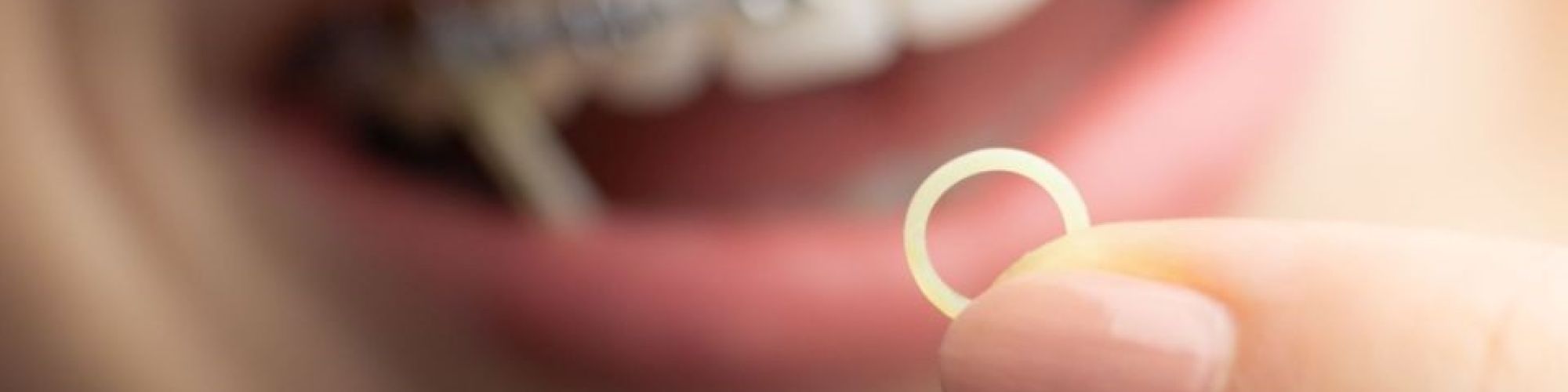 Centra Dental - Why Are Rubber Bands Used in South Houston Braces Treatment?