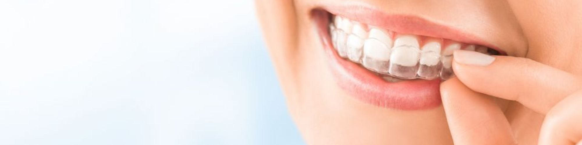 Centra Dental - How To Keep Up Good Hygiene While Wearing Houston Invisalign