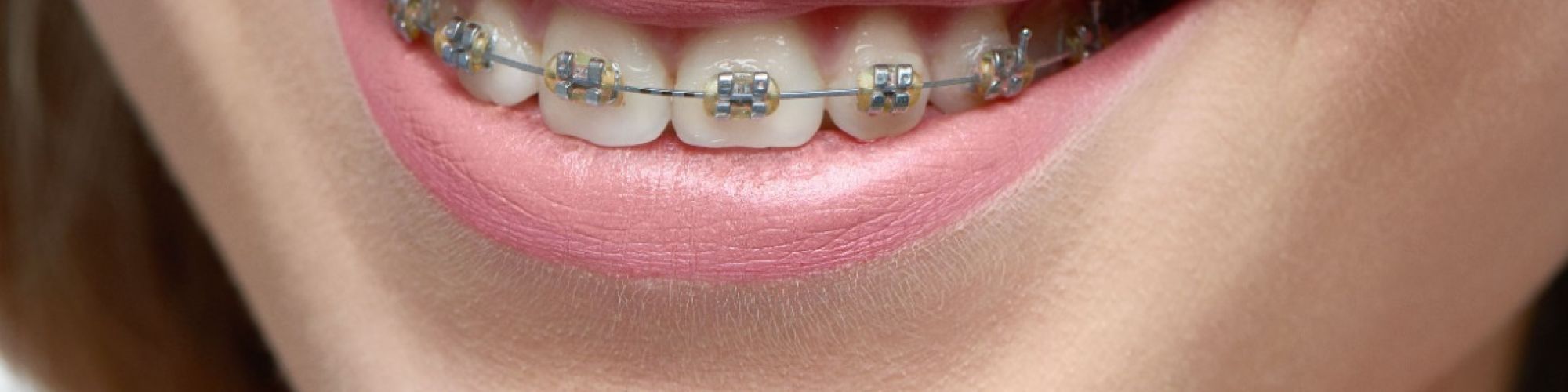 Centra Dental - Top 5 South Houston Braces Maintenance Tips