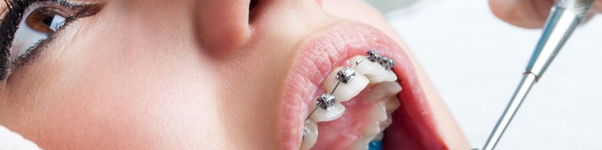 Centra Dental - Early Orthodontics Affected by Lack of Dental Visits