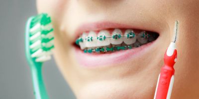 Centra Dental - Good Hygiene While Wearing Houston Braces