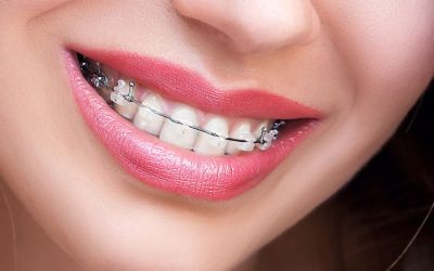 Centra Dental - Ceramic South Houston Braces versus Metal Braces