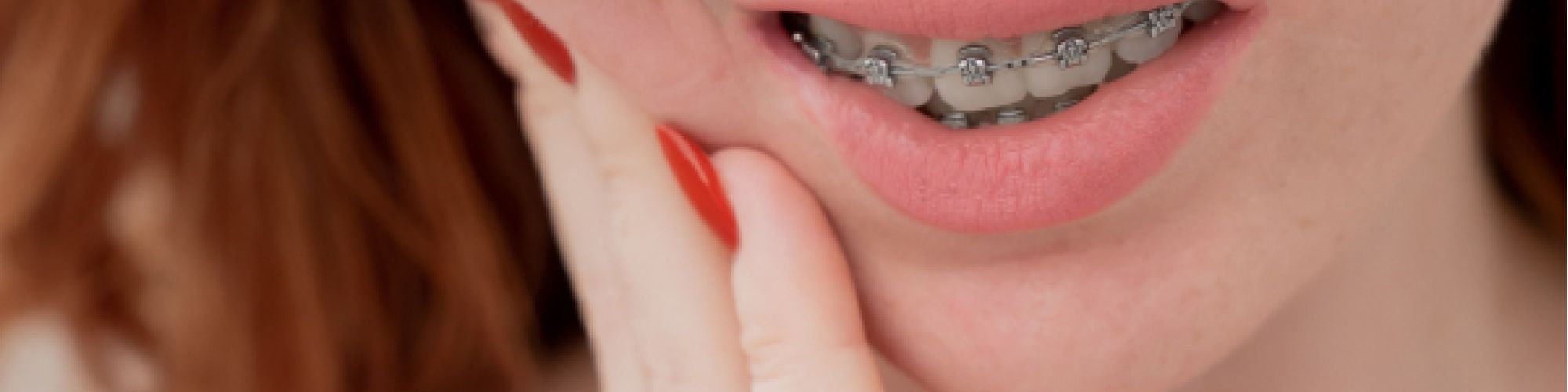 Centra Dental - How to Deal with Discomfort from South Houston Braces