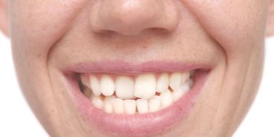 Centra Dental - Why You May Need Braces