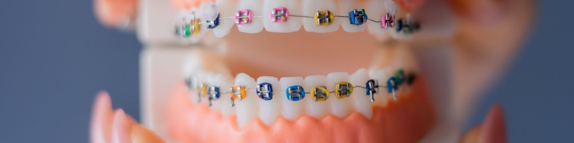 Centra Dental - Are Metal South Houston Braces Better Than Ceramic?