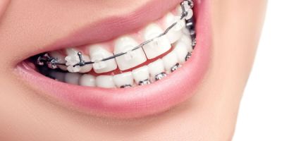 Centra Dental - When to Consider Houston Ceramic Braces for Your Child