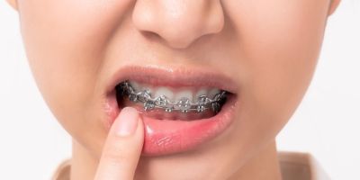 Centra Dental - How to Manage ﻿Houston Braces Pain