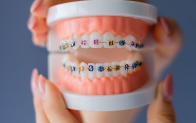 Centra Dental - Are Metal South Houston Braces Better Than Ceramic?