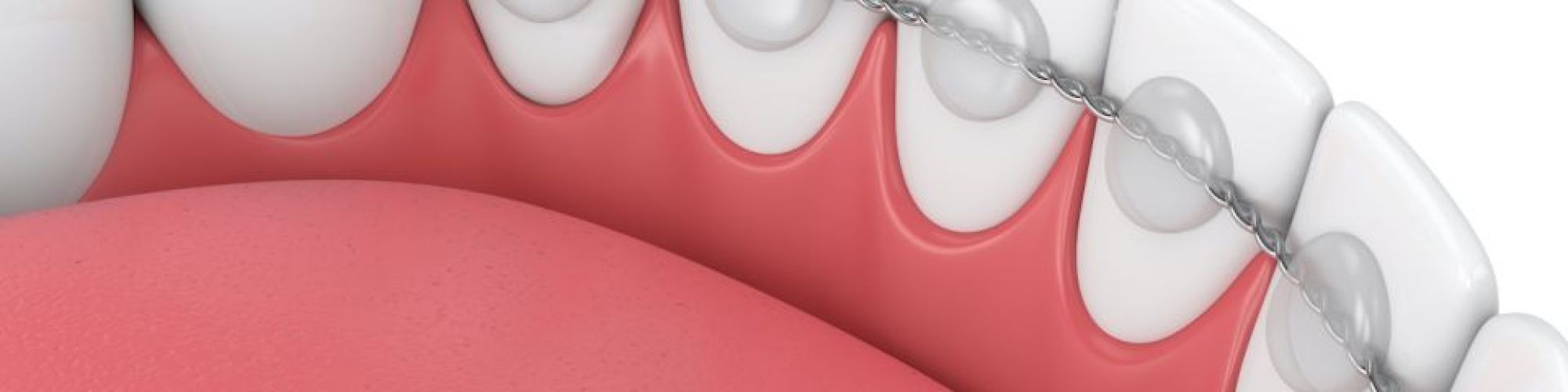 Centra Dental - Pros and Cons of Bonded Orthodontic Retainers After Houston Braces