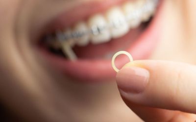 Centra Dental - Do All Houston Braces Patients Need Rubber Bands?