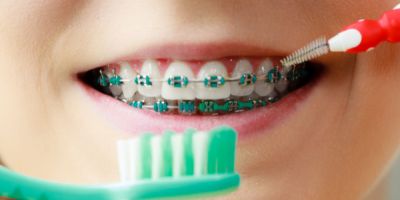 Centra Dental - The Importance of Proper Hygiene and Dental Check-Ups When Wearing South Houston Braces
